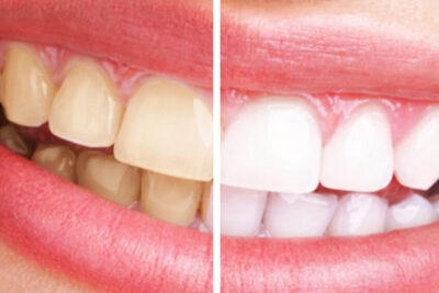 imagen de una sonrisa radiante y saludable con dientes blancos y sin sarro