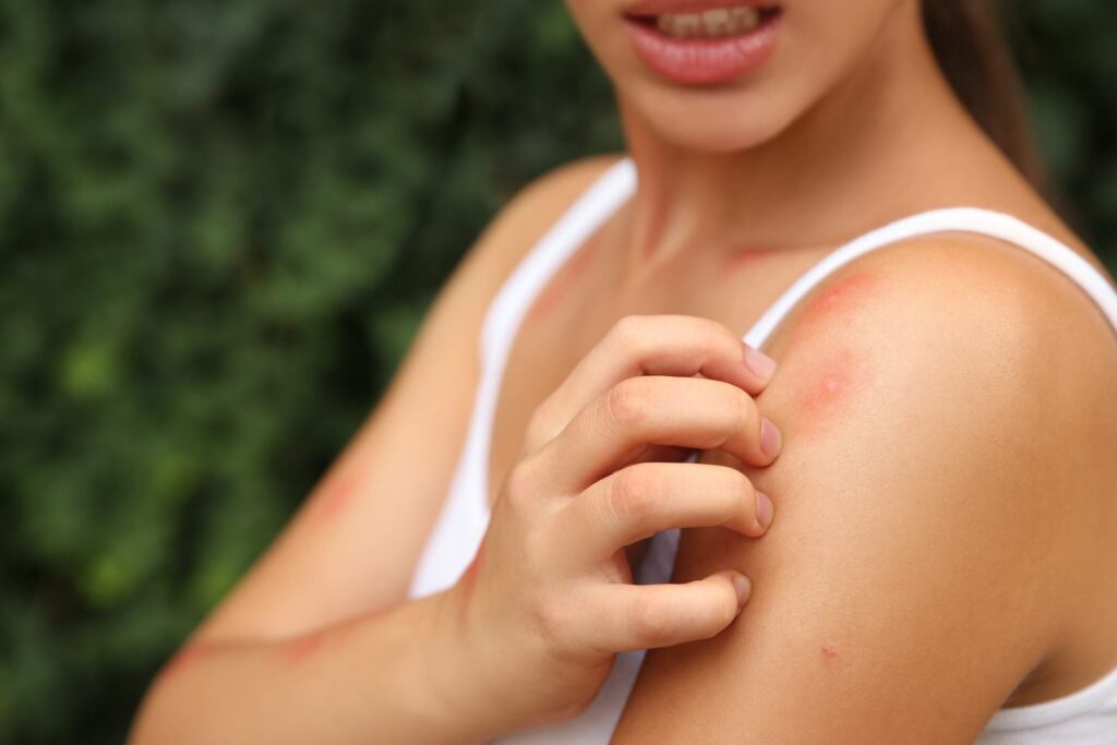 una imagen de una persona aplicando repelente de mosquitos en su piel