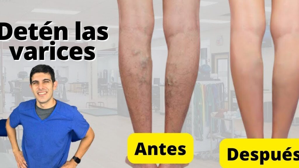 una imagen de una persona haciendo ejercicio para prevenir las varices