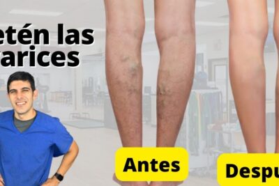 una imagen de una persona haciendo ejercicio para prevenir las varices
